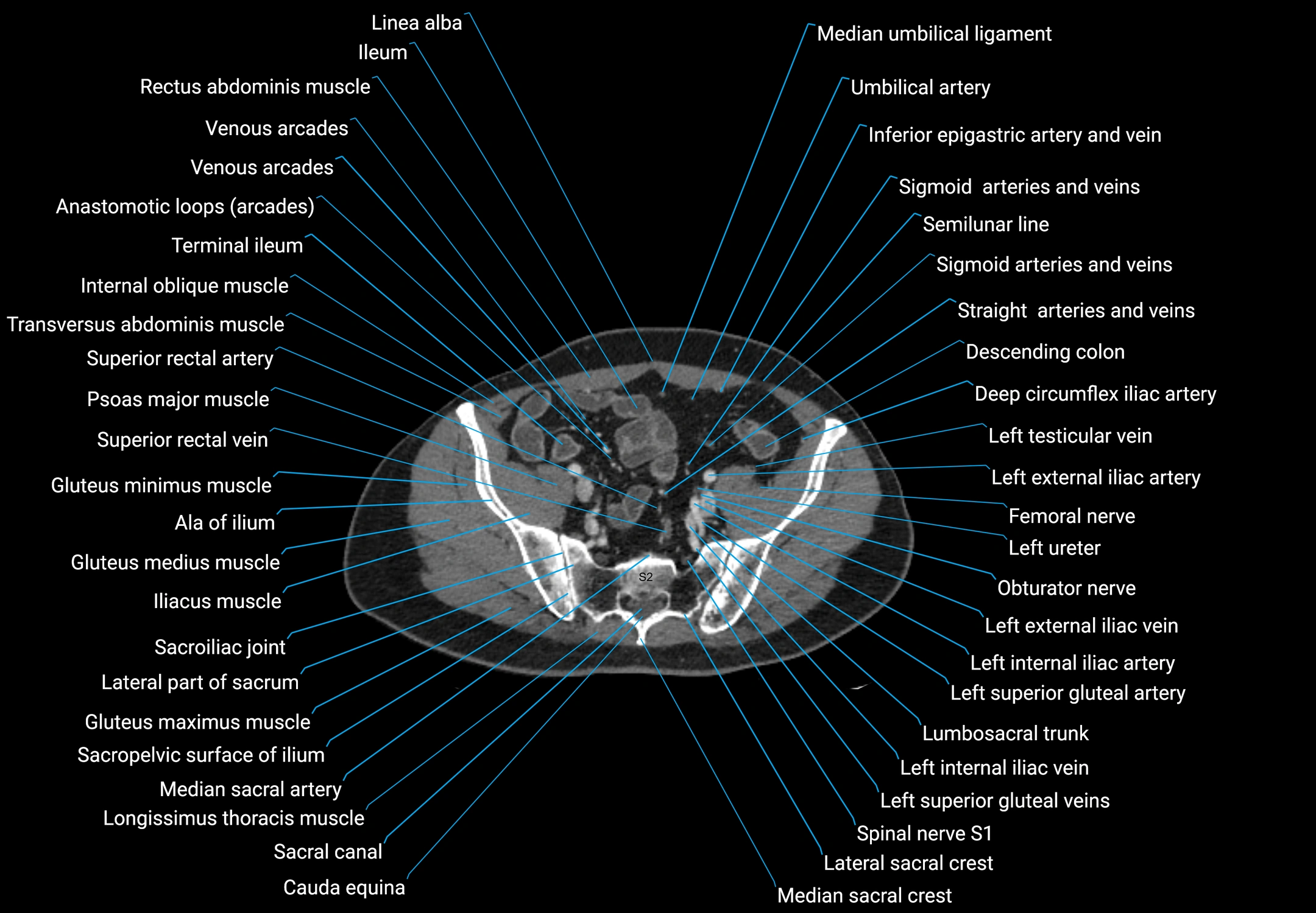 CT male pelvis axial cross sectional anatomy labelled radiology image -00151.webp